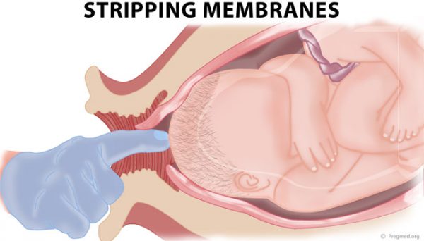 membrane sweep at 39 weeks success rate