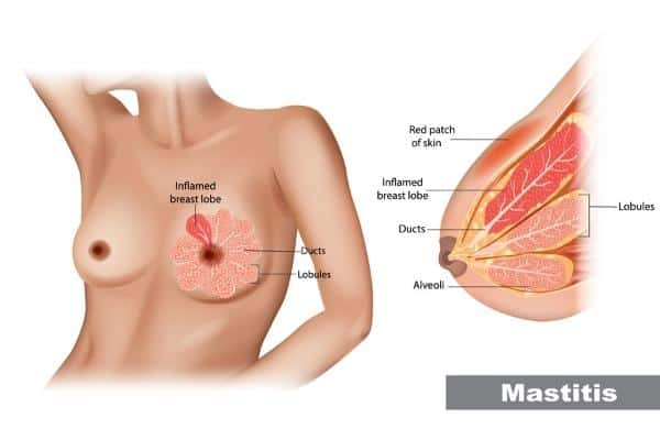 graphic of breast anatomy during mastitis
