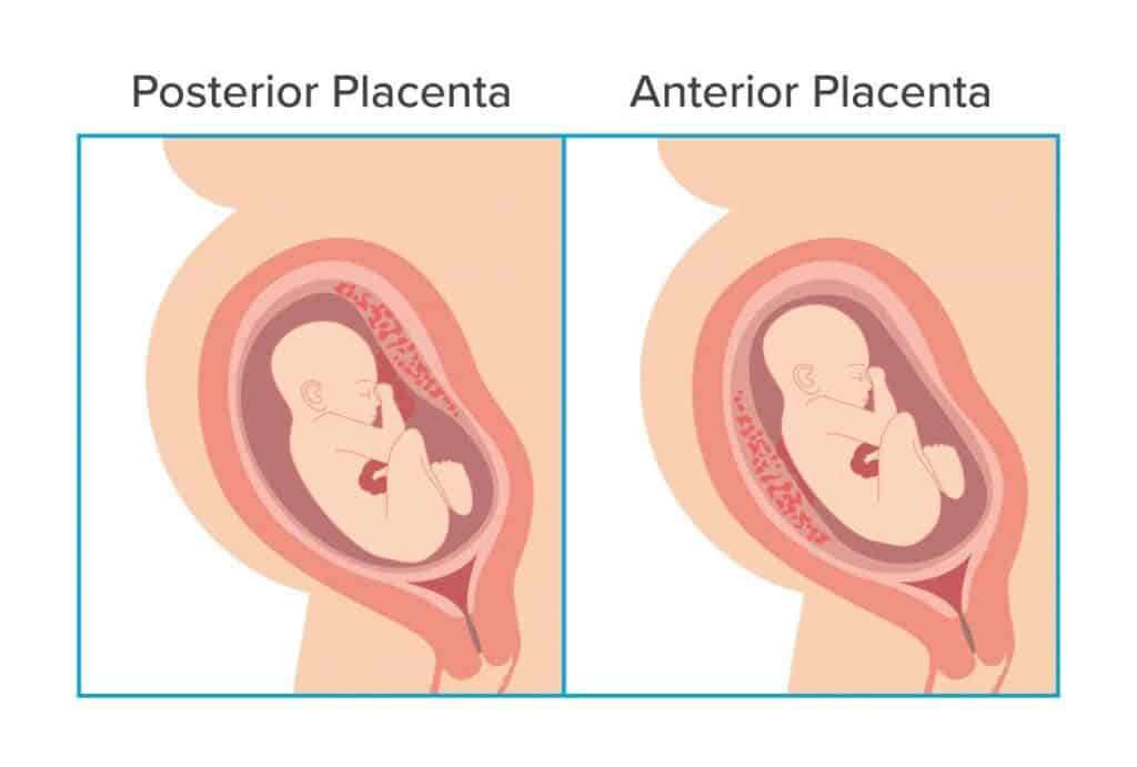 posterior vs anterior placenta